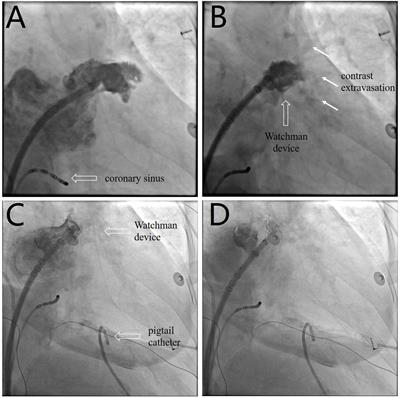 Case report: Intrapericardial thrombus aspiration in early stage of pericardial thrombosis for cardiac tamponade complicating percutaneous left atrial appendage closure